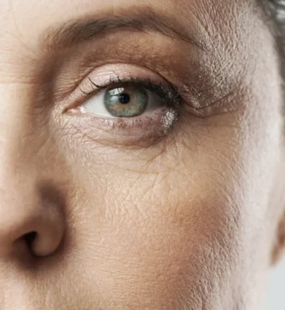 Skin regeneration treatment